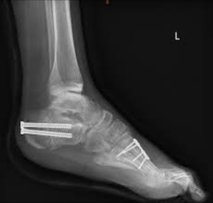 A lateral X-ray of a left foot and ankle showing surgical screws and hardware from corrective foot and ankle surgery.